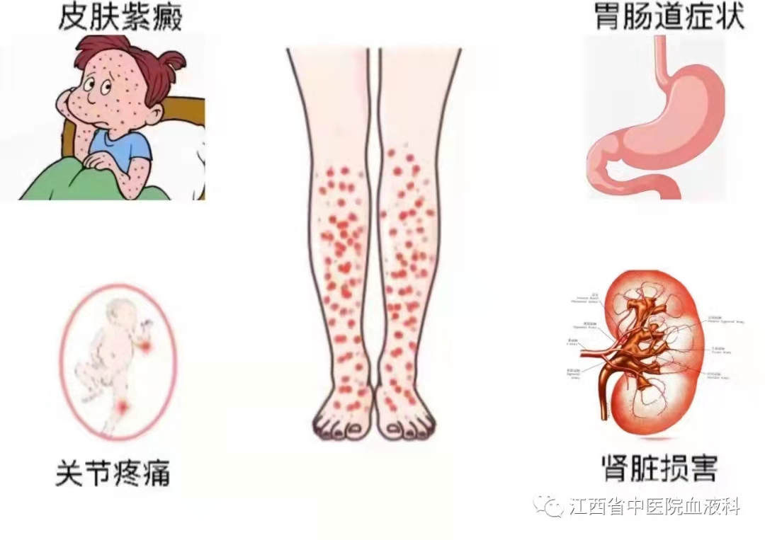 过敏性紫癜你了解多少