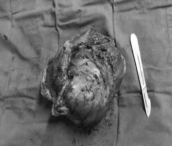 江西省中医院成功实施一例小腿大块肿瘤体切除术