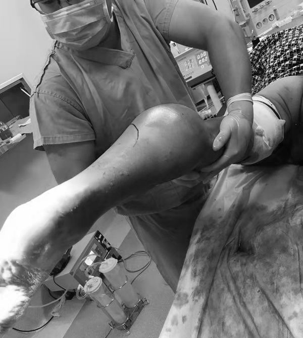 健康正常的右小腿相应位置周径为29cm,患病左腿囊肿达19cm,近乎两个